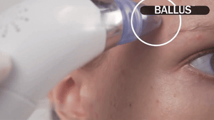 Pore Cleaning Device AnsCart